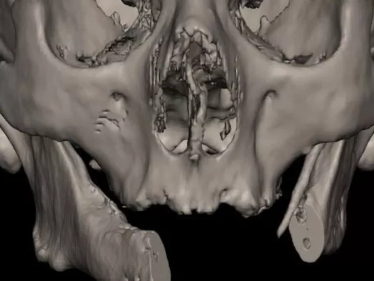 3D-s eljárások az orvostechnikában
