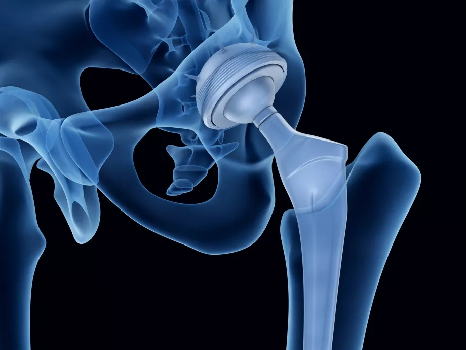 Szuperelasztikus fémötvözetből készülhetnek a jövő orvosi implantátumai
